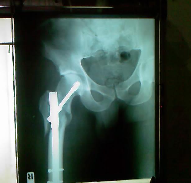 femur.jpg
