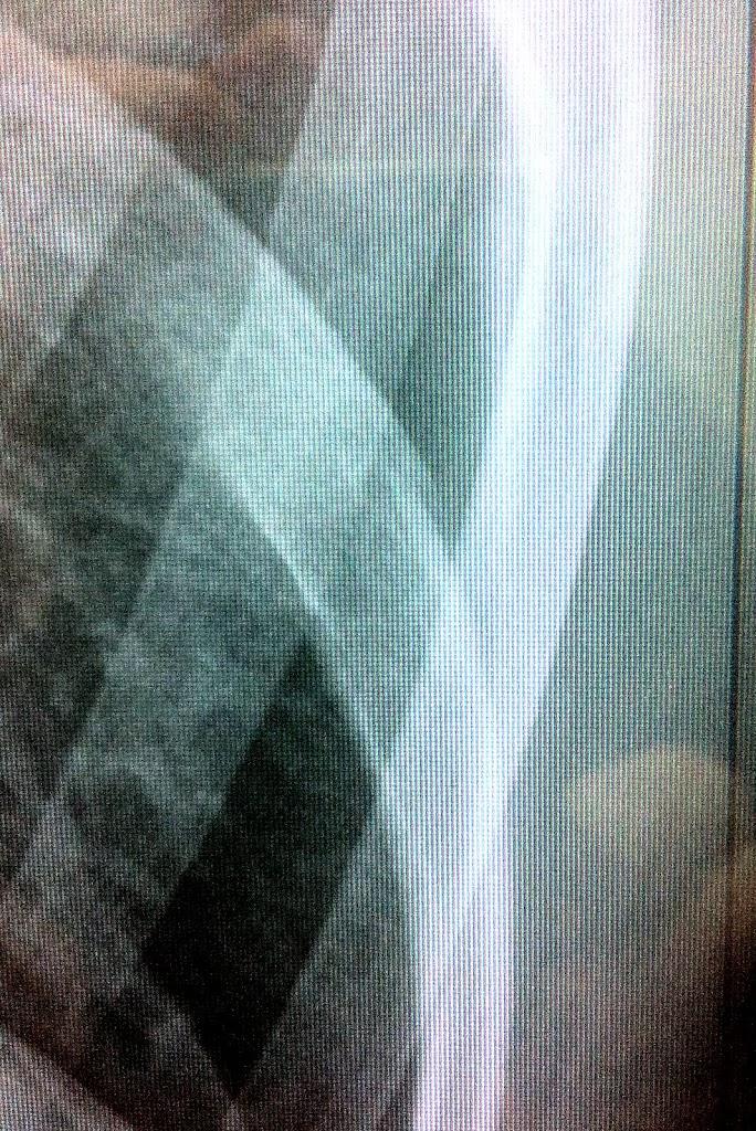 rib_fracture.jpg